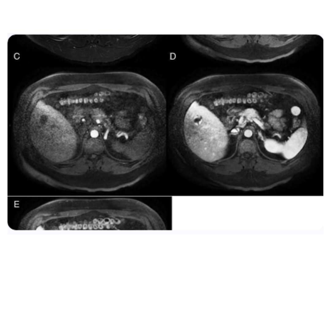 Resonancia magnética cerebral en blanco y negro con cortes transversales que muestran la anatomía del cerebro en detalle.