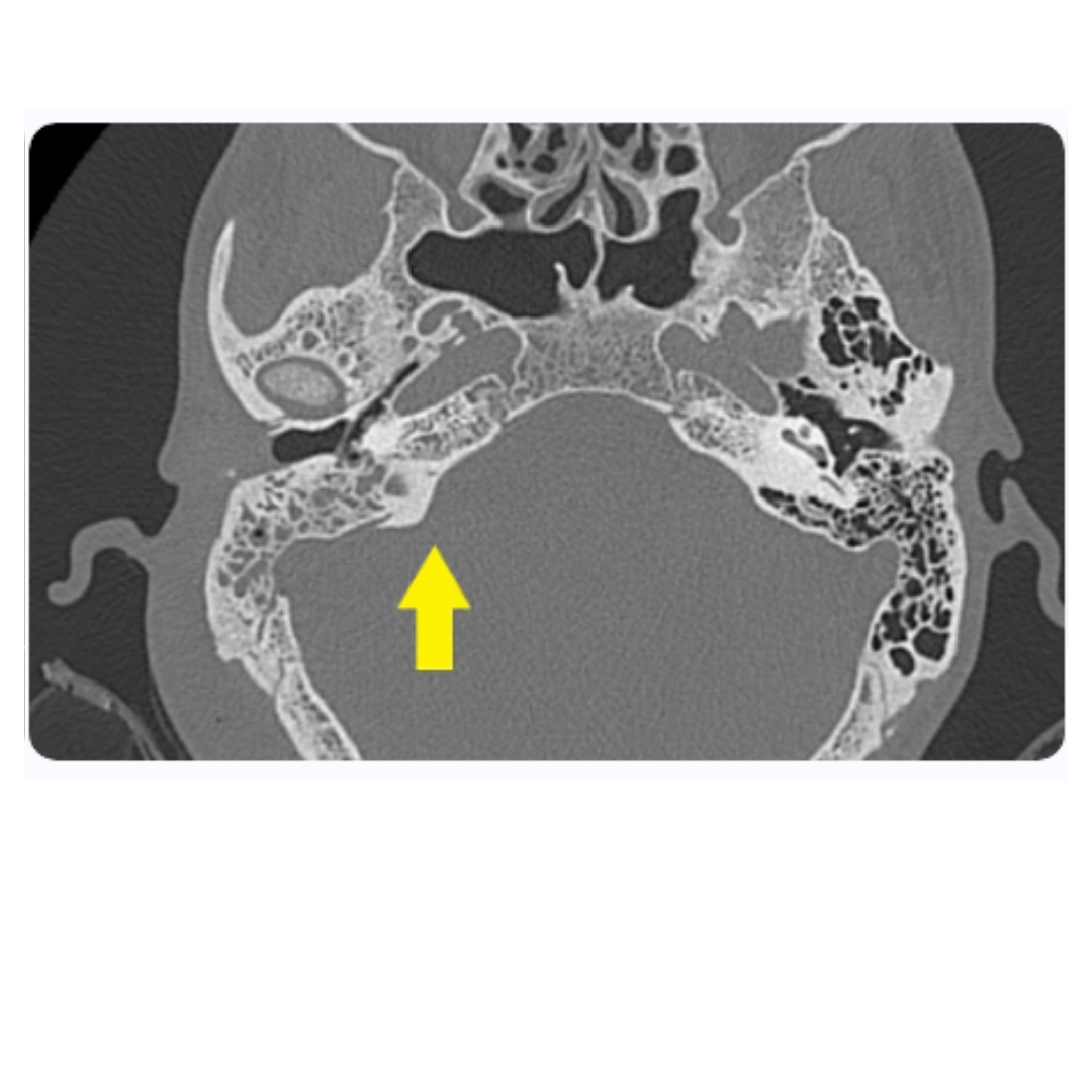 Tomografía computarizada de tórax en corte axial, visualizando pulmones, corazón y posibles irregularidades en el tejido pulmonar o mediastino.
