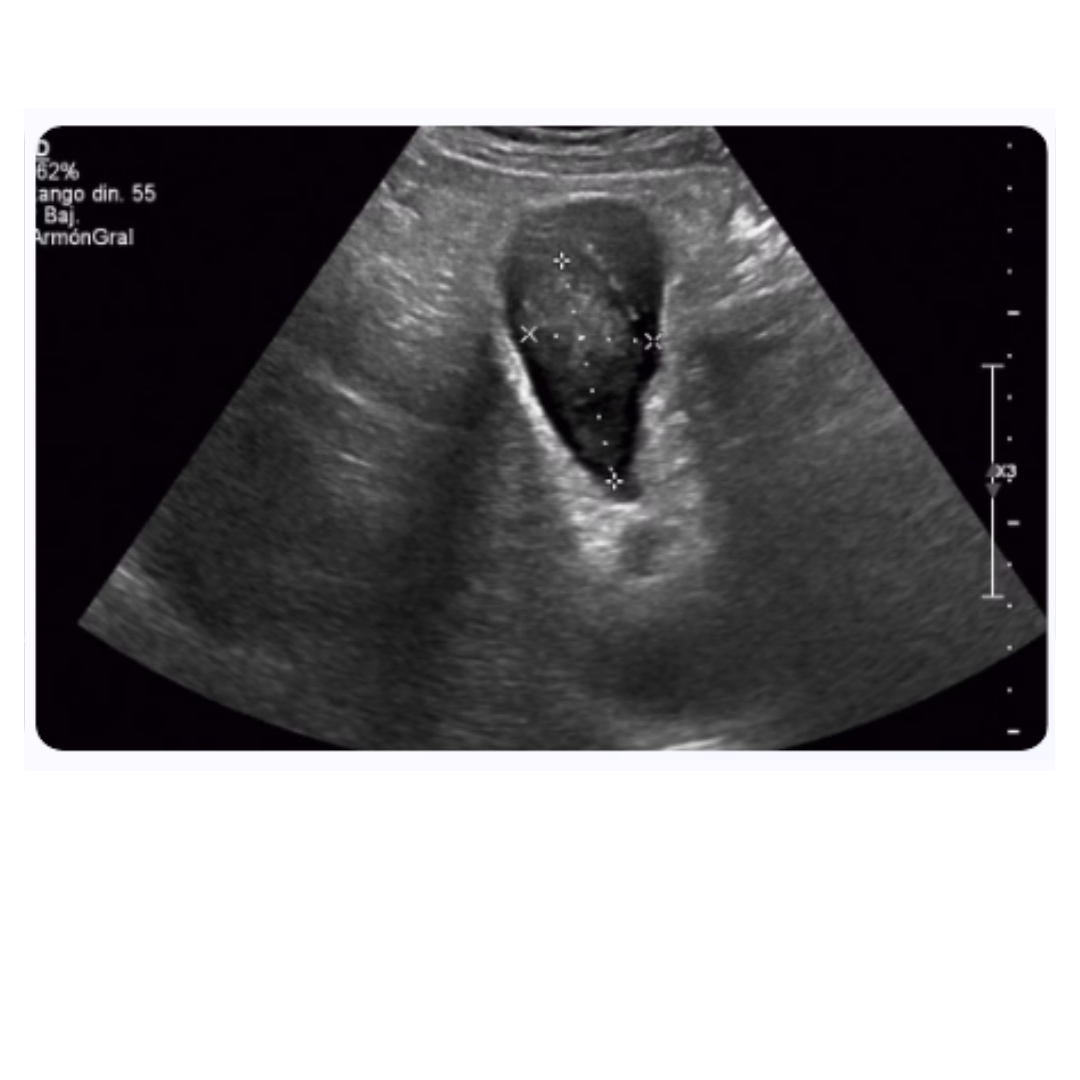 Ecografía Doppler abdominal que muestra un área ovalada oscura (vaso sanguíneo) sobre fondo granular claro, usado para evaluar circulación y órganos como hígado o riñones.