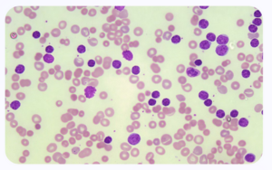 Microscopía de células sanguíneas teñidas de rosa y púrpura, mostrando diferencias en tamaño y forma en fondo claro.